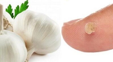 liečba bradavíc ľudovými prostriedkami