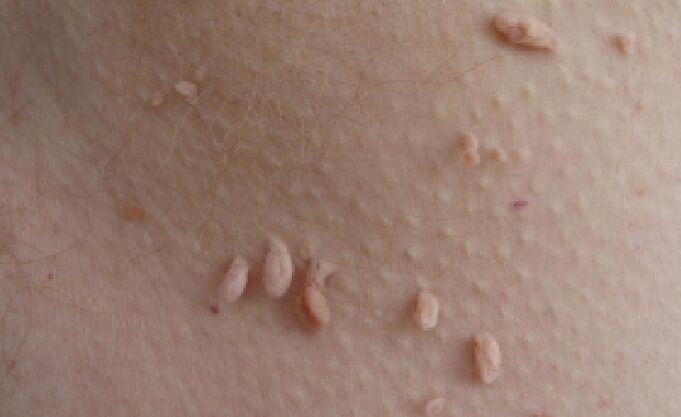 dôvody pre výskyt papilómov na ľudskom tele