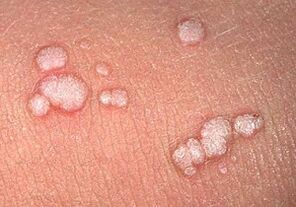 vulgárne papilómy na ľudskom tele