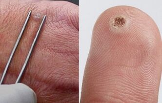 príznaky papilómov na ľudskom tele